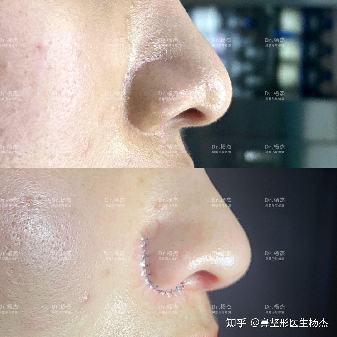 永井宏治 | 鼻尖修复+硅胶隆鼻+鼻翼缩小 - 知乎