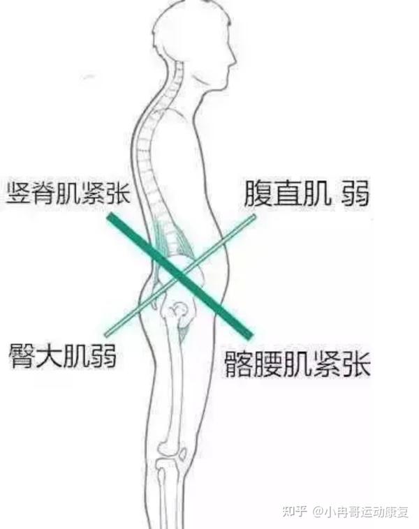 冉冉科普 体态矫正之【下交叉综合征】 知乎 7393