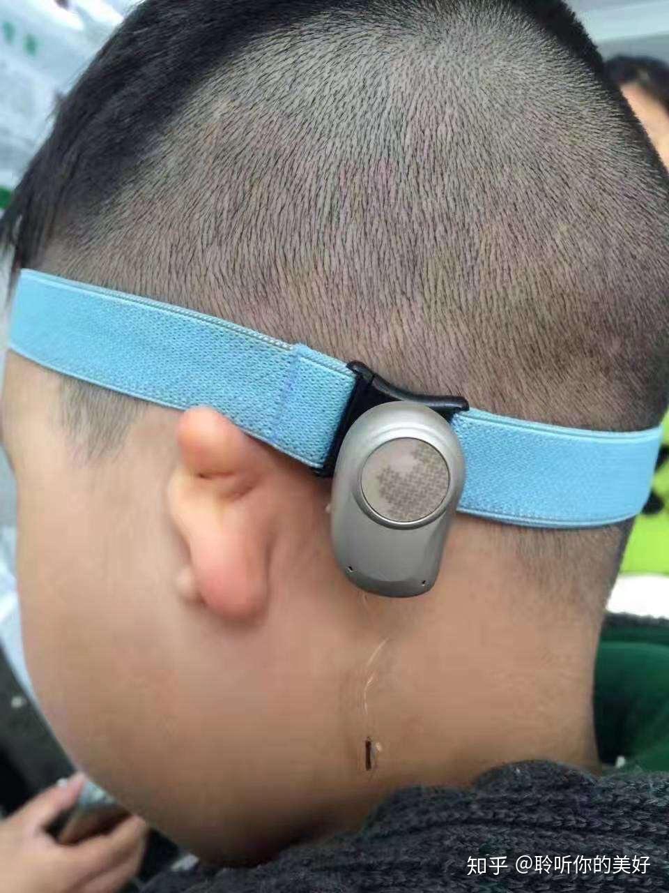 单侧耳聋适合戴助听器吗骨导助听器怎么样