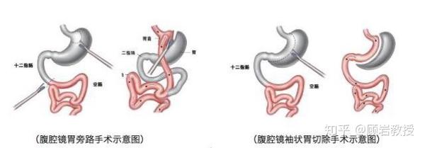 减肥手术多少钱_手术减肥_减肥手术是怎么做的