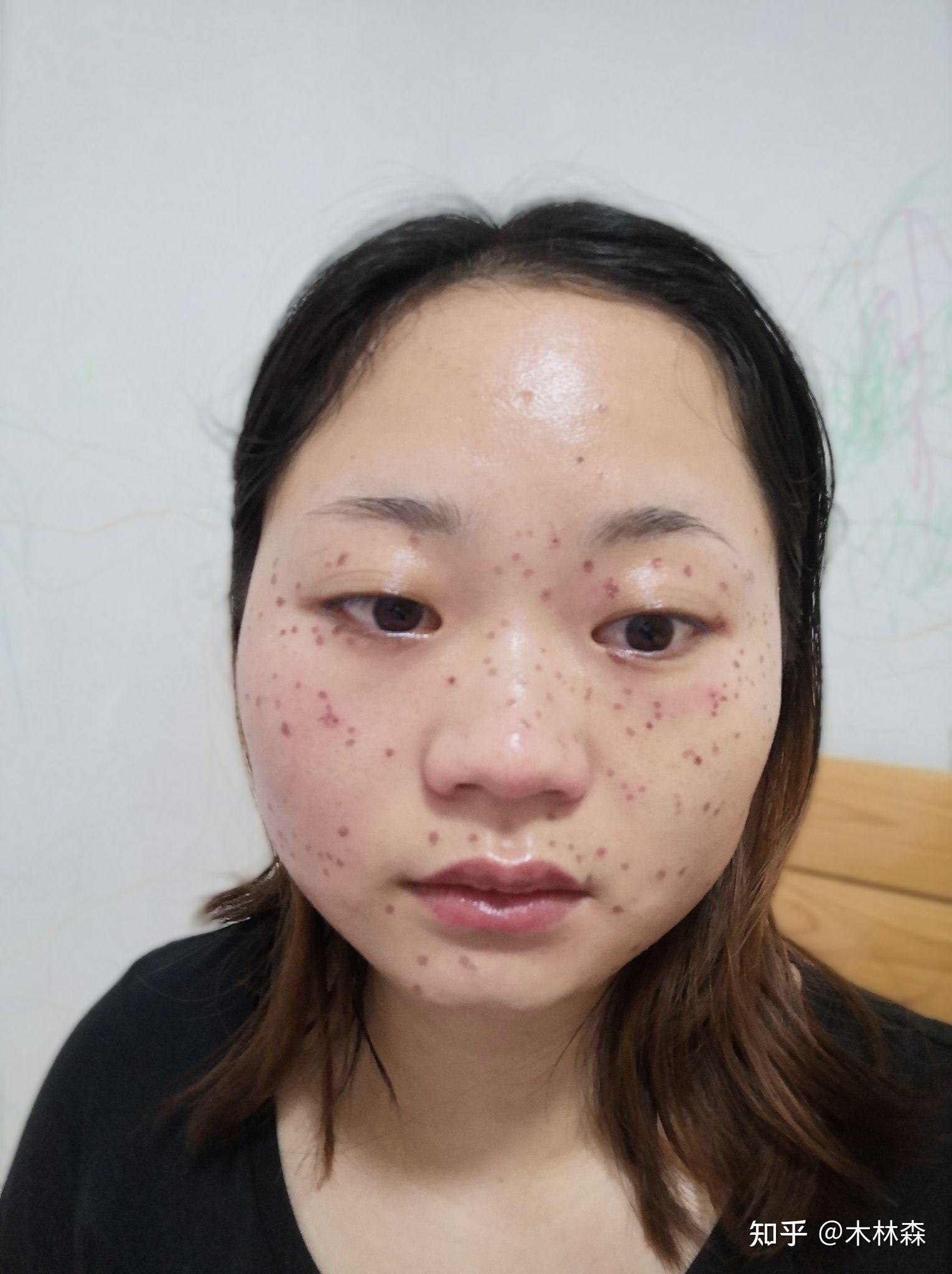 生物酶祛斑,记录一下难过的尴尬期 - 知乎