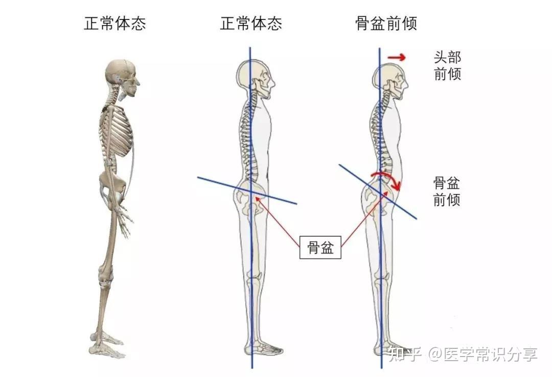 为什么会骨盆前倾