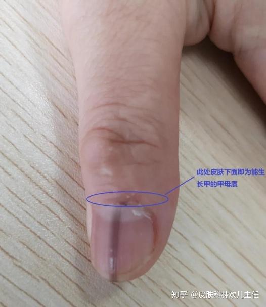 它也是由痣细胞构成,不同的是长在了甲母质(指/趾甲生长的部位)或甲床