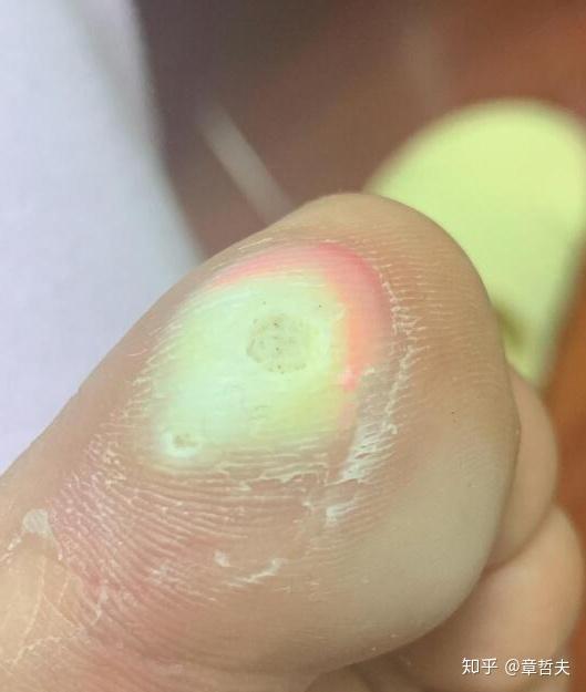 你确定脚上长的是鸡眼?说不定是. - 知乎