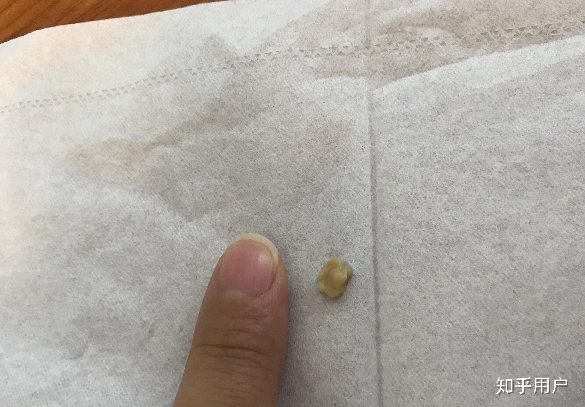 你见过最大的扁桃体结石有多大?