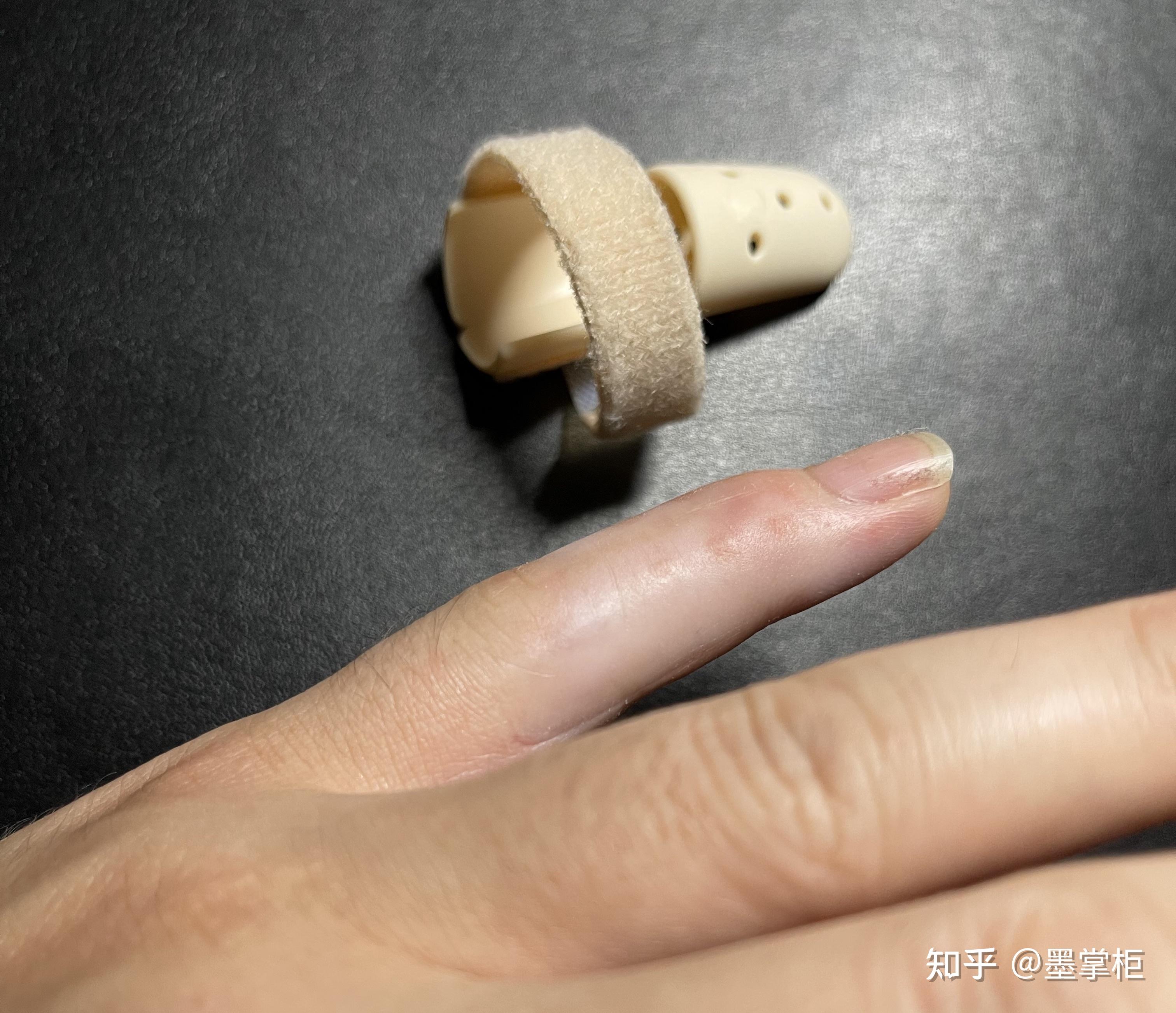 锤状指背伸肌腱损伤治疗记录