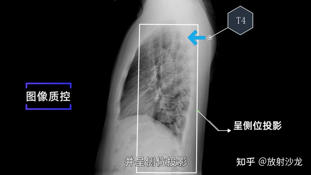 x线规范化检查 | 胸部正侧位摄影