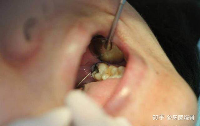 1,不能用舌头去舔伤口,尽量少说话,24小时后才能刷牙漱口,可用kin吉兰