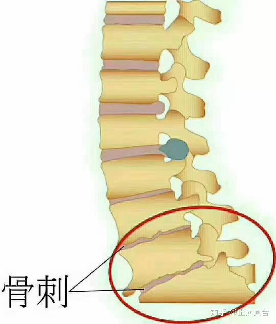 骨质增生的形成骨质增生通常又叫骨刺骨赘