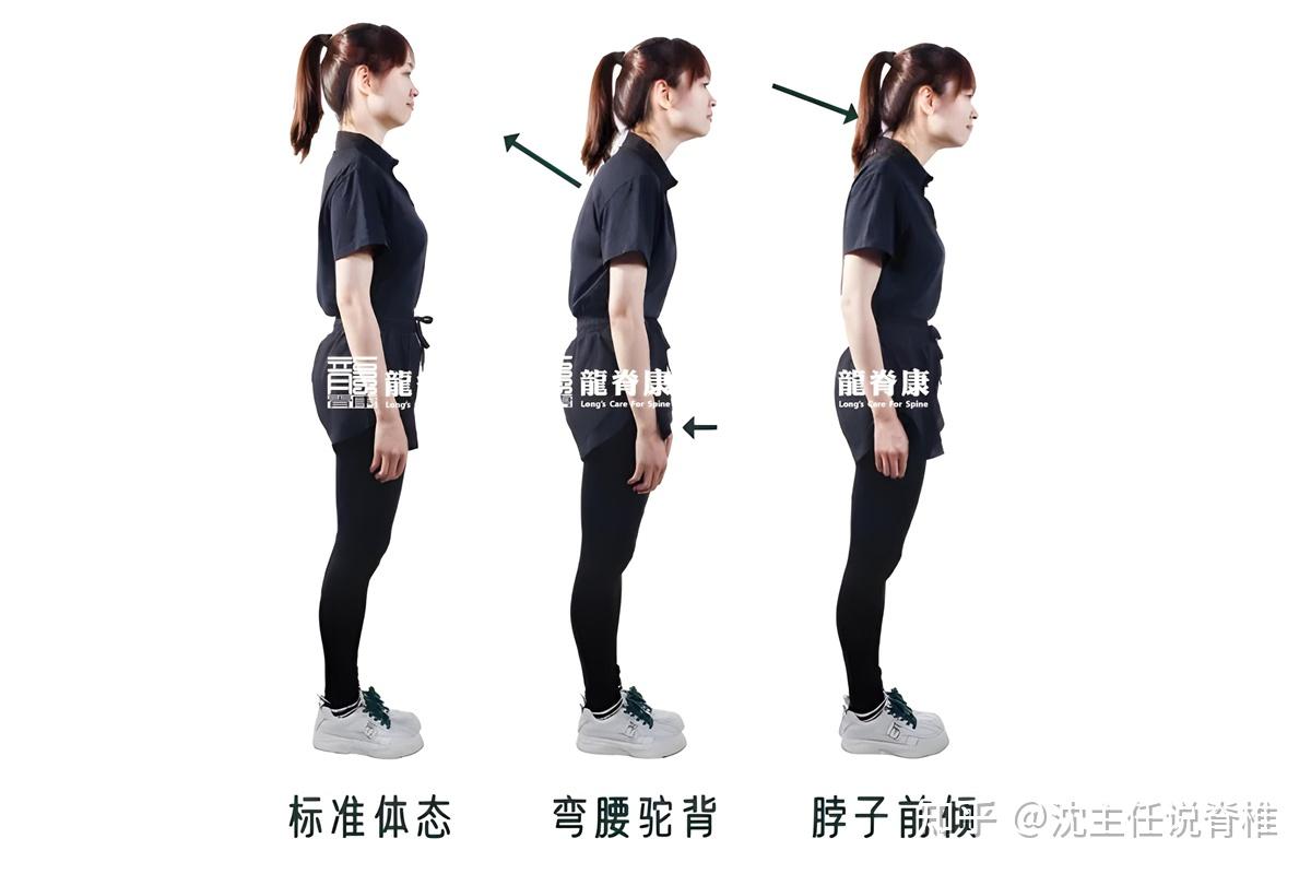 每天“腰背挺直”还是会驼背,如何改善?4个动作有效告别驼背 - 知乎