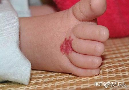 新生儿身上长胎记 哪些能自行消退 知乎