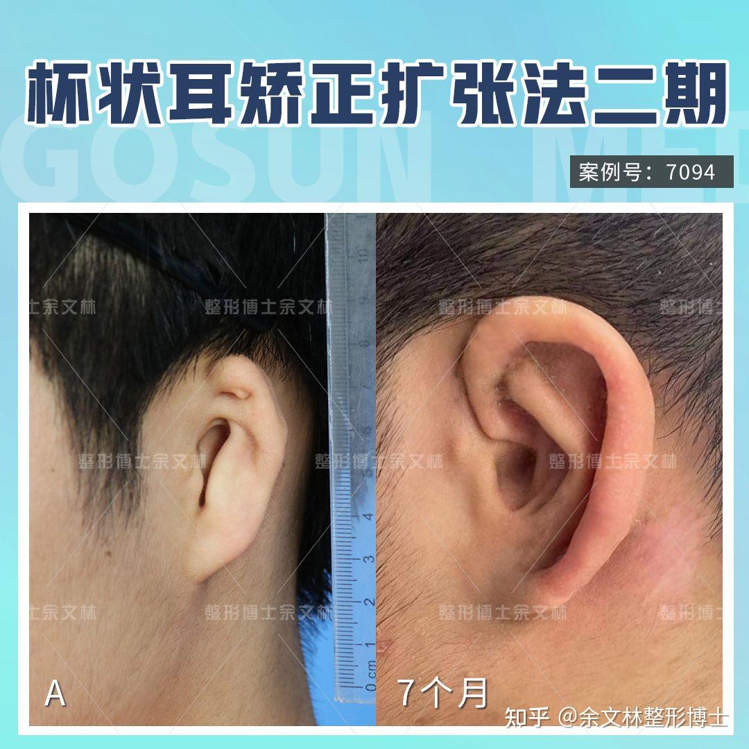 耳整形术 | 德玛思特美容门诊部