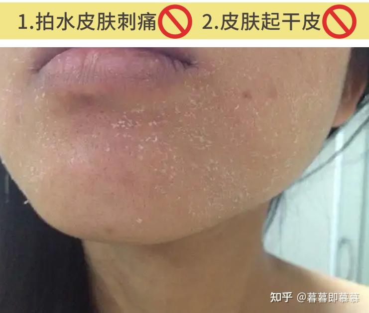 春季脸部皮肤太干燥了严重缺水怎么办用什么补水最快最有效精