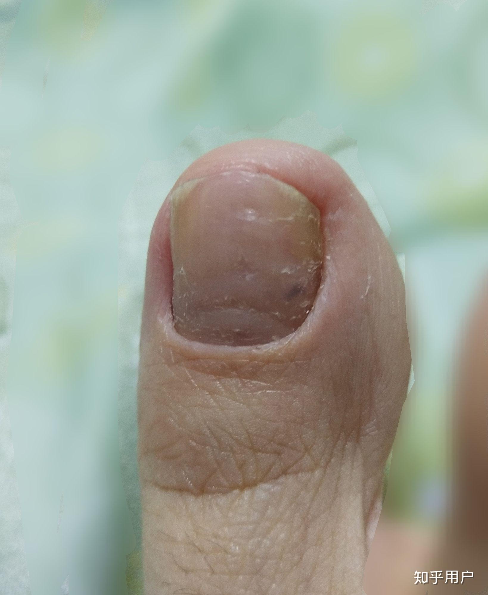 脚趾甲里出现一黑点是怎么回事?