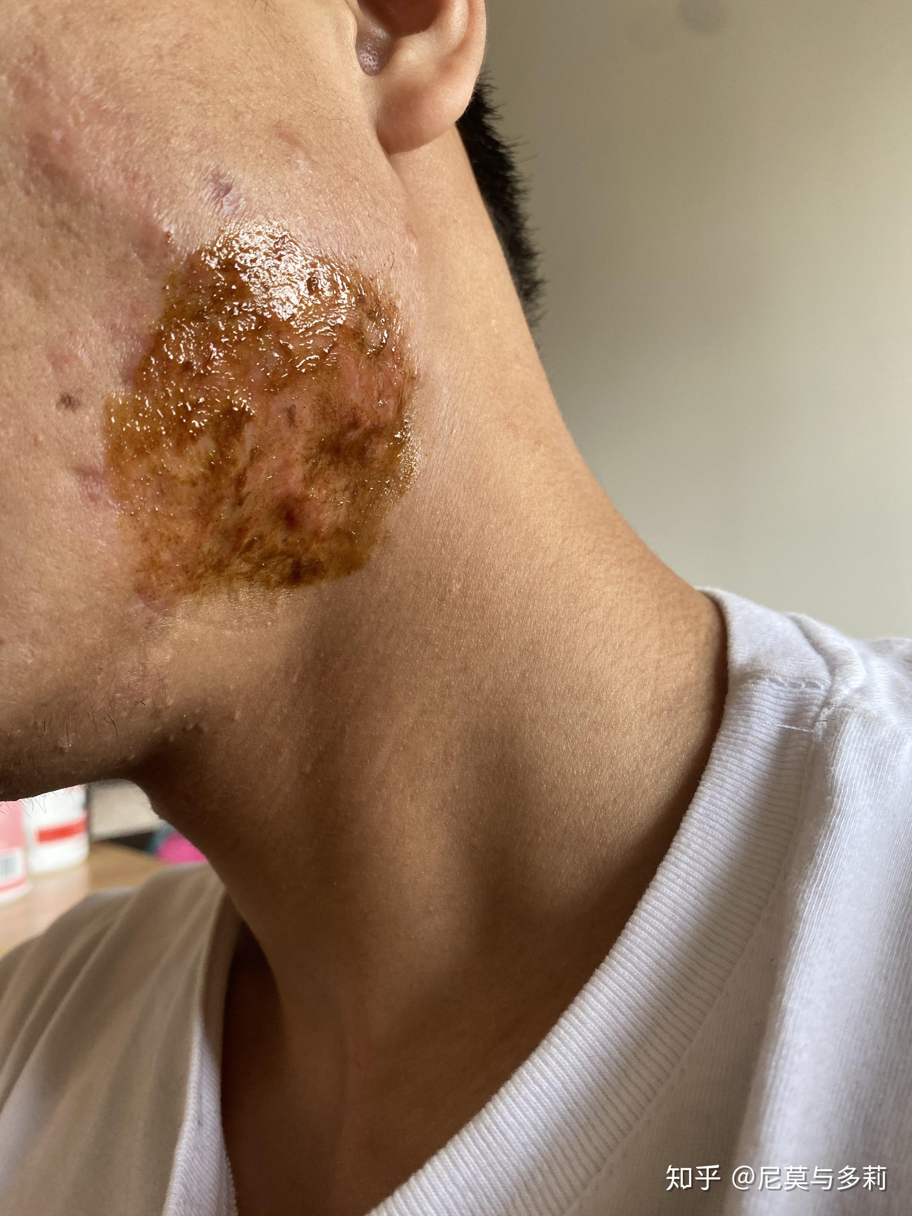 困扰我两年的腮部疤痕疙瘩现在正在得以正确的治疗盗图必究严禁取我的