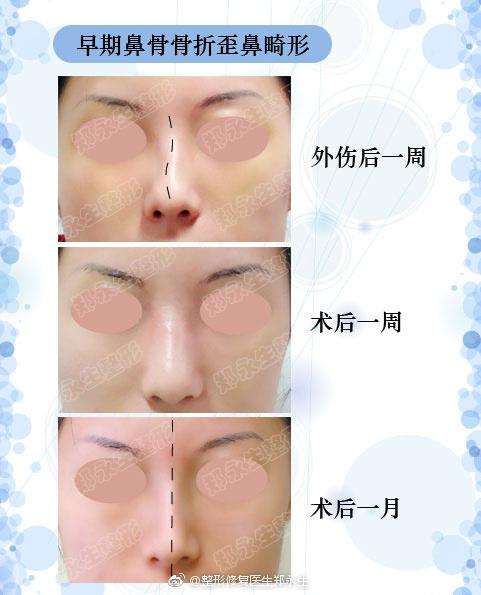 摔伤了当时鼻子没有问题 后来怎么突然发现鼻子歪了呢 知乎