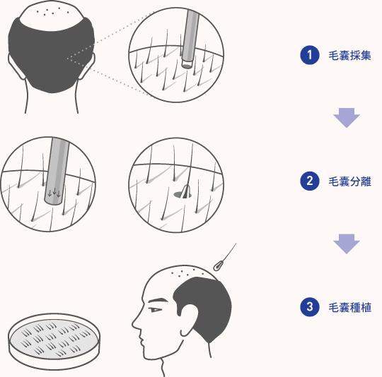 额角脱发还能长回来嘛? - 知乎