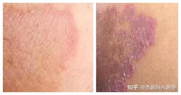 请问这种属于什么皮肤病? - 知乎