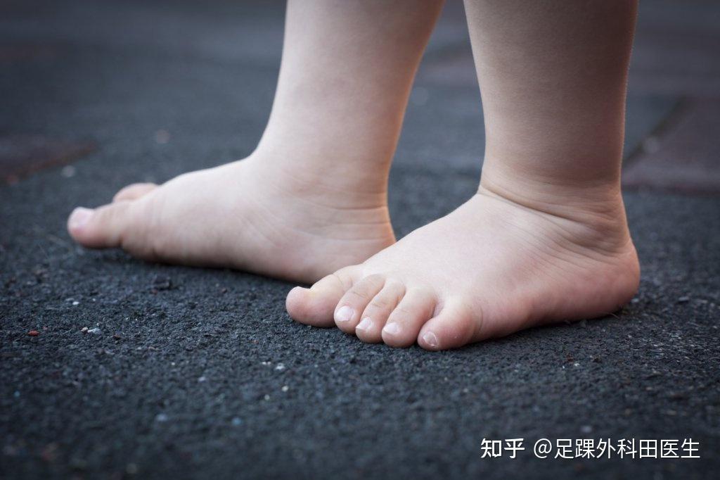都有平足,这是他们足部正常发育的一部分,随着生长发育,足弓继续发育