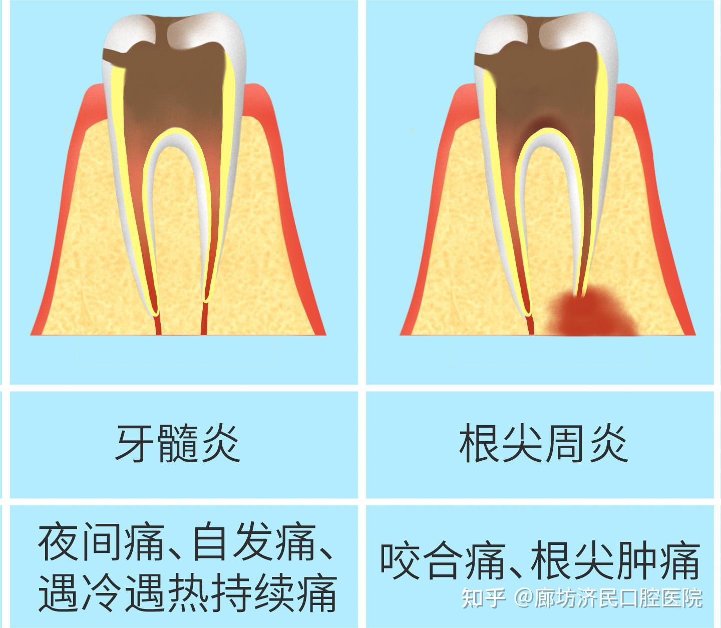 牙齿忽然“长高”？原来它才是元凶——根尖周炎！ - 知乎
