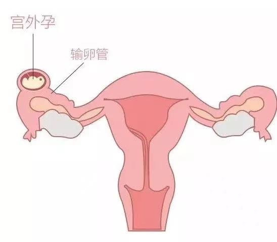 输卵管堵塞的症状