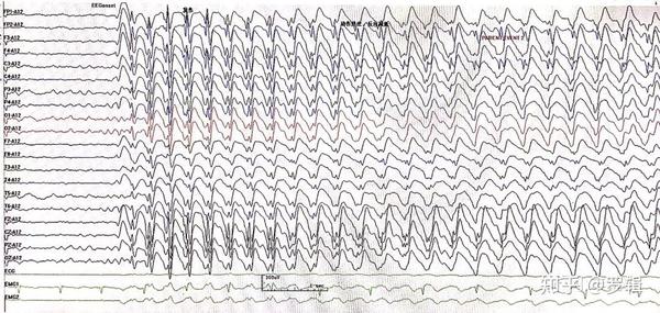 热性惊厥脑电图图片