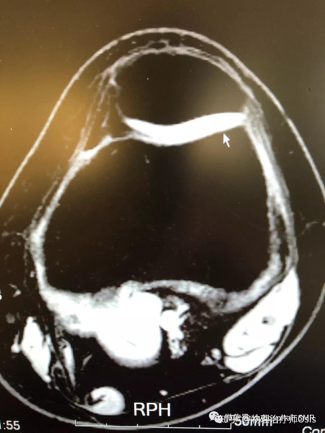 髌骨软化核磁共振图像图片
