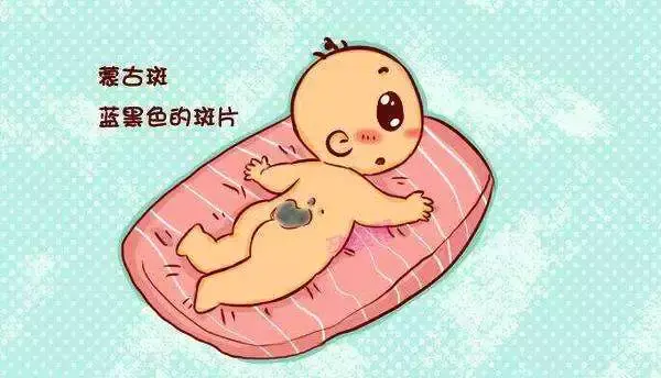 宝宝胎记要不要治疗