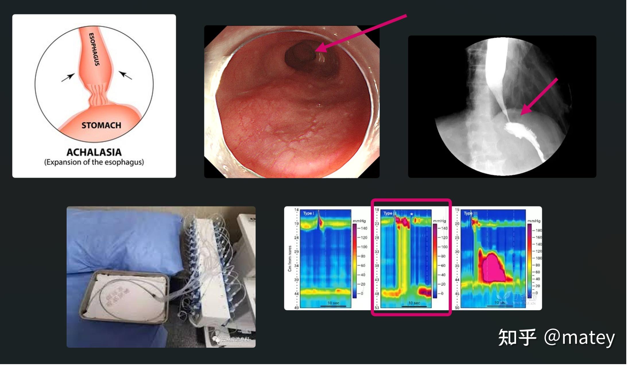 POEM手术：开启贲门失弛缓康复之门 - 知乎