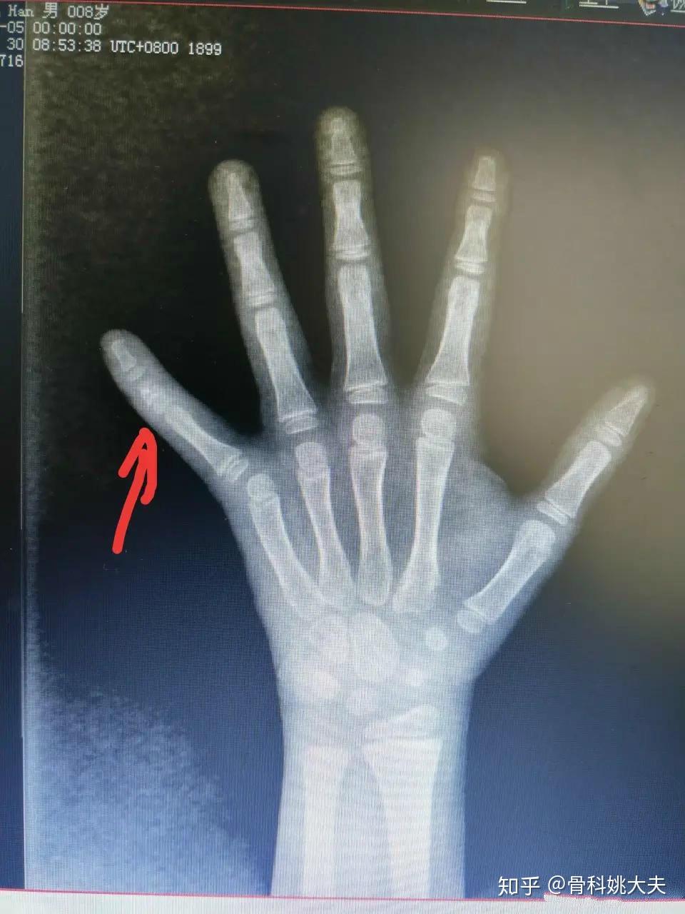 手指拇指籽骨x光片图图片
