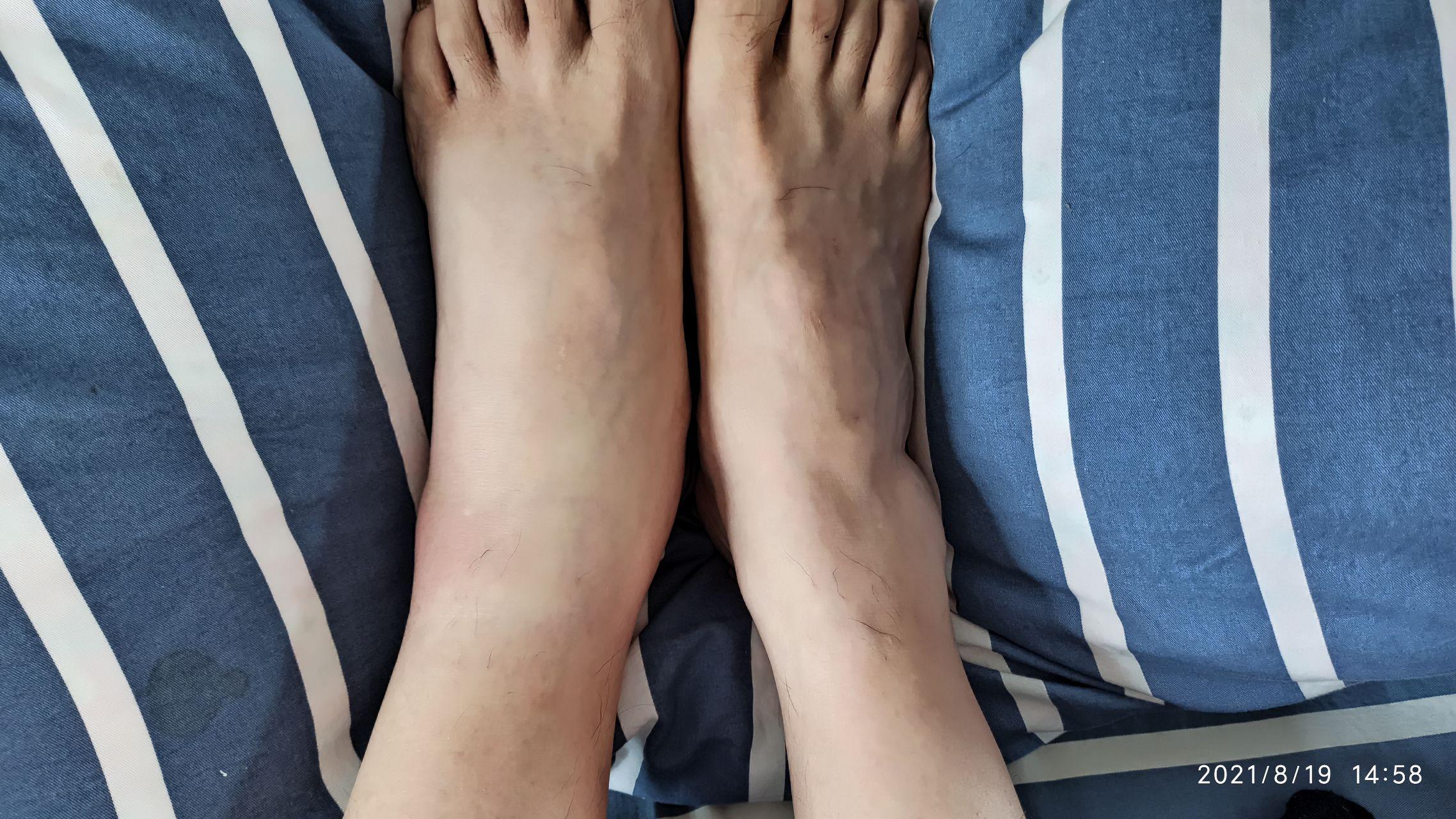 牛皮癣愈合后,被蜜蜂蛰了 - 知乎