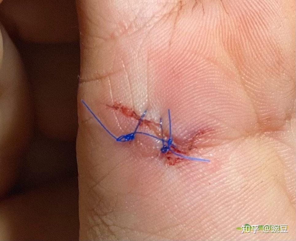 拆线时间口诀 知乎