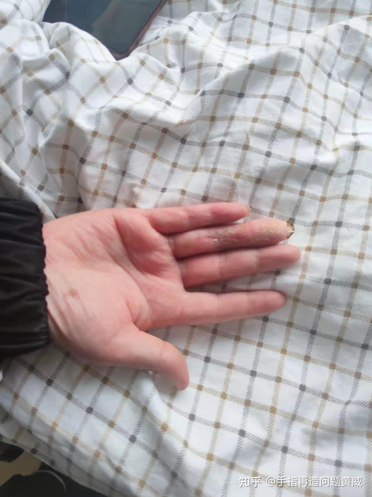六指症手术风险大吗?什么治疗方式最可靠? - 知乎