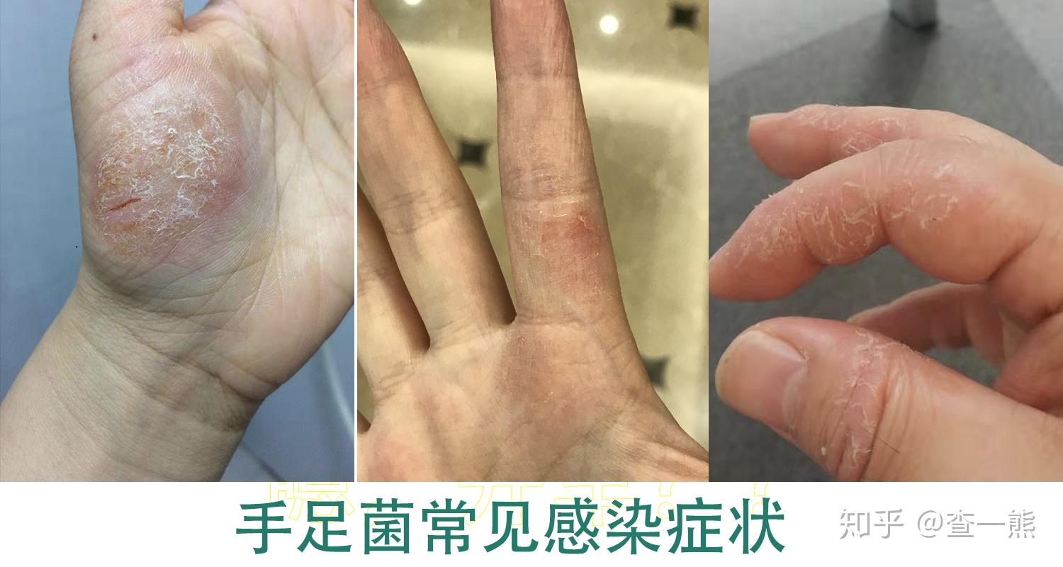 脚气会传染到手上吗