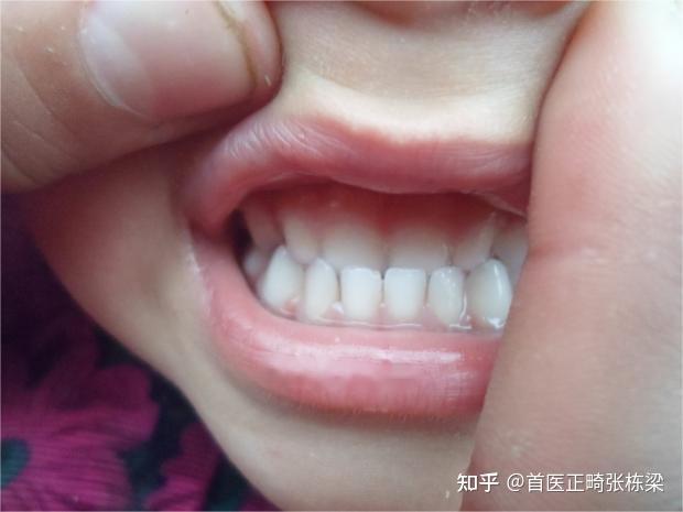 儿童牙齿矫正反颌(地包天)别错过这个黄金年龄!如何矫正?专家给出答案! - 知乎
