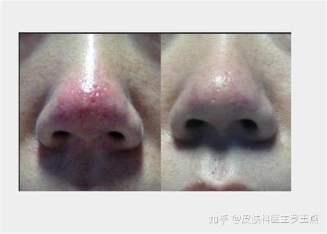 草莓鼻和酒糟鼻的图图片