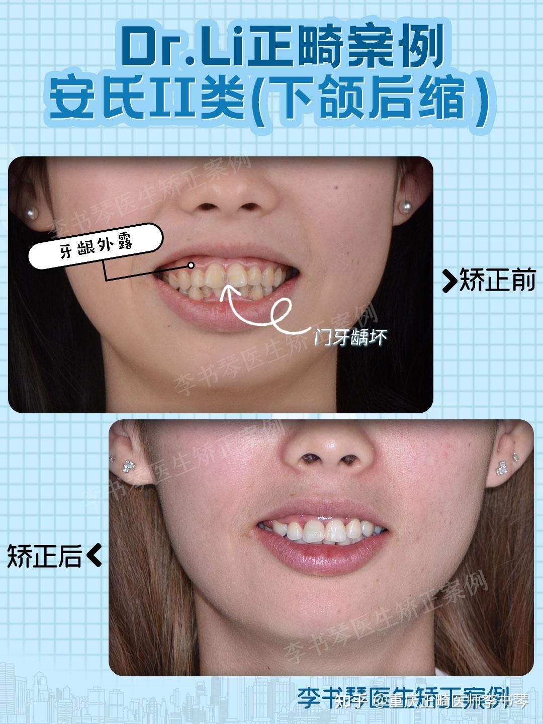 成都牙齿矫正【案例】—牙齿前突+下颌后缩+牙齿稀疏 - 知乎