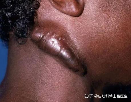 瘢痕疙瘩的综合治疗相关(干,全面) - 知乎