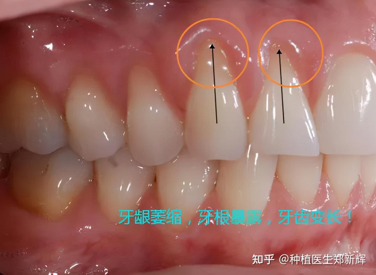 不想牙齦萎縮請把精力花在這