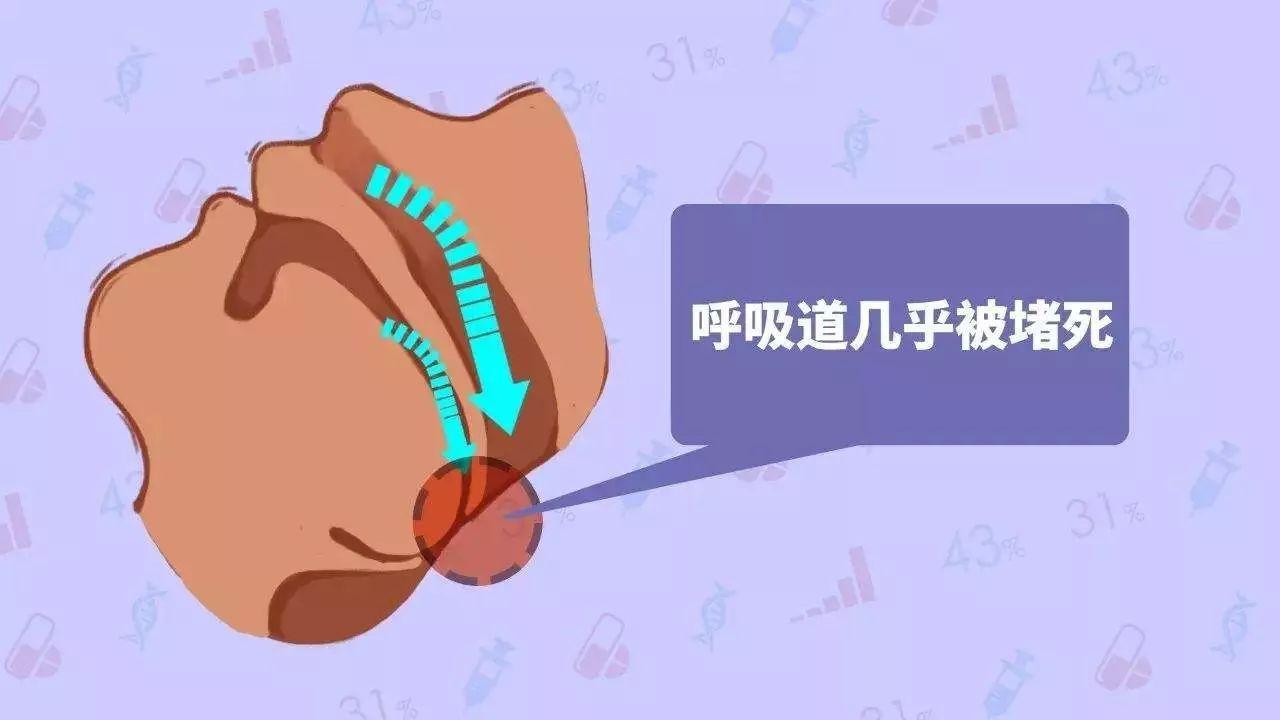 气流须经过柔软而有弹性的咽部组织,如软腭,悬雍垂,扁桃体和舌.