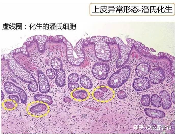 从健康的胃黏膜到肠化生病变 就是这样一步步衍变的