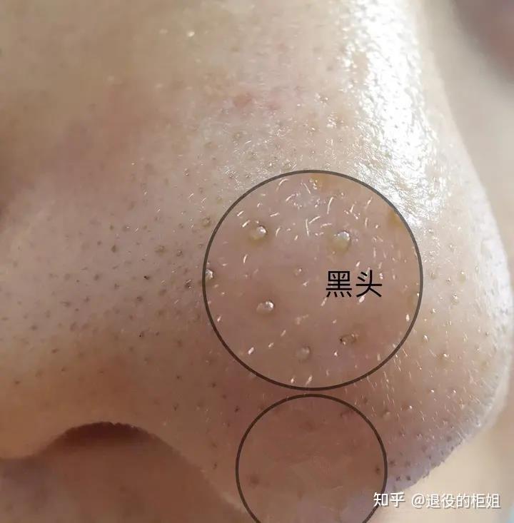 对于复杂型的黑头该怎么去处理? - 知乎