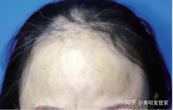 菏泽治疗脱发植发(菏泽哪里看生发看的好)