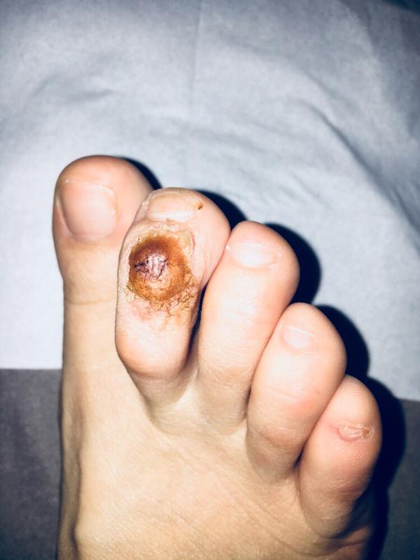 脚趾关节处形成的老茧鸡眼怎么去除