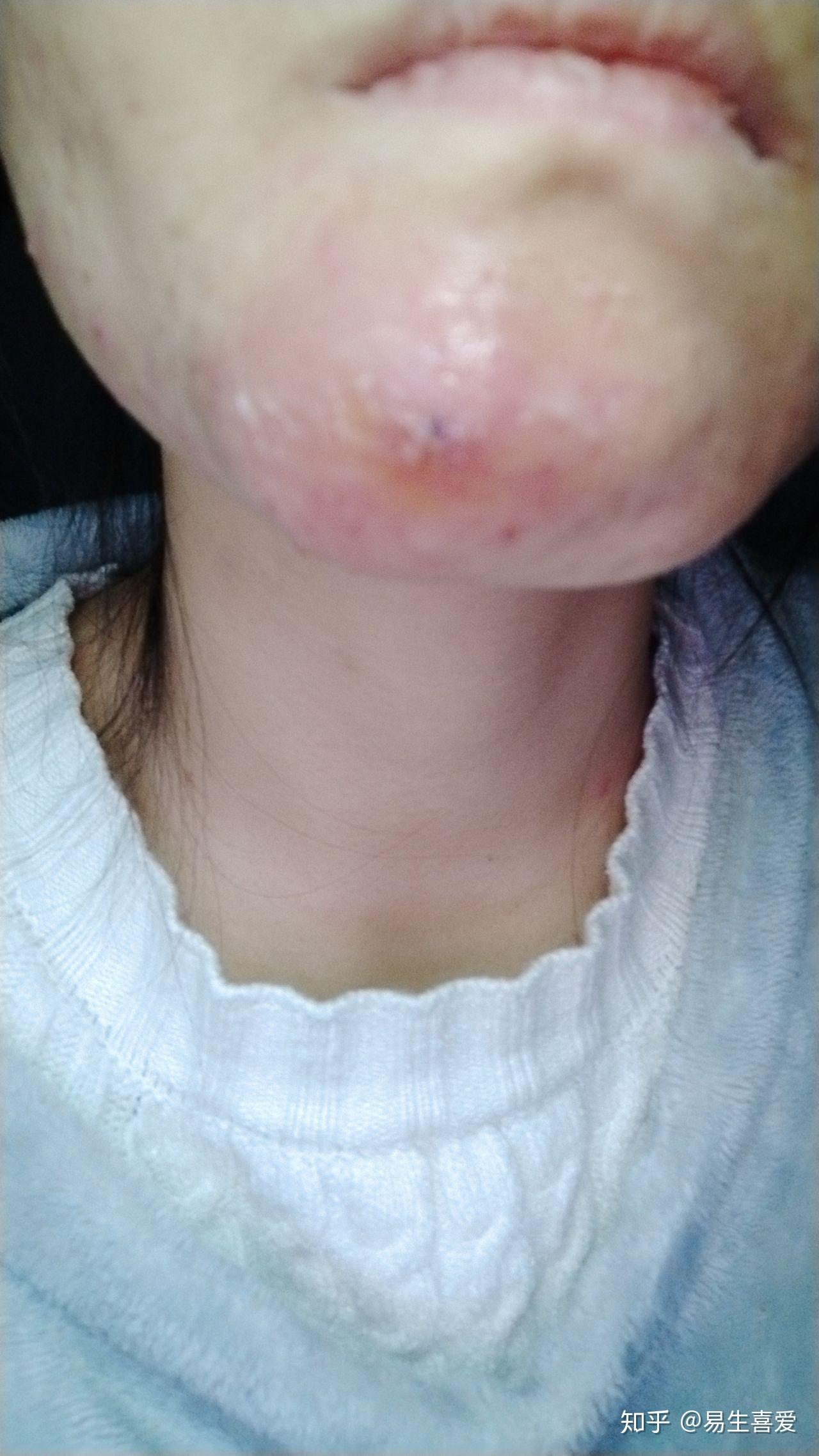 疖肿治疗亲身得过