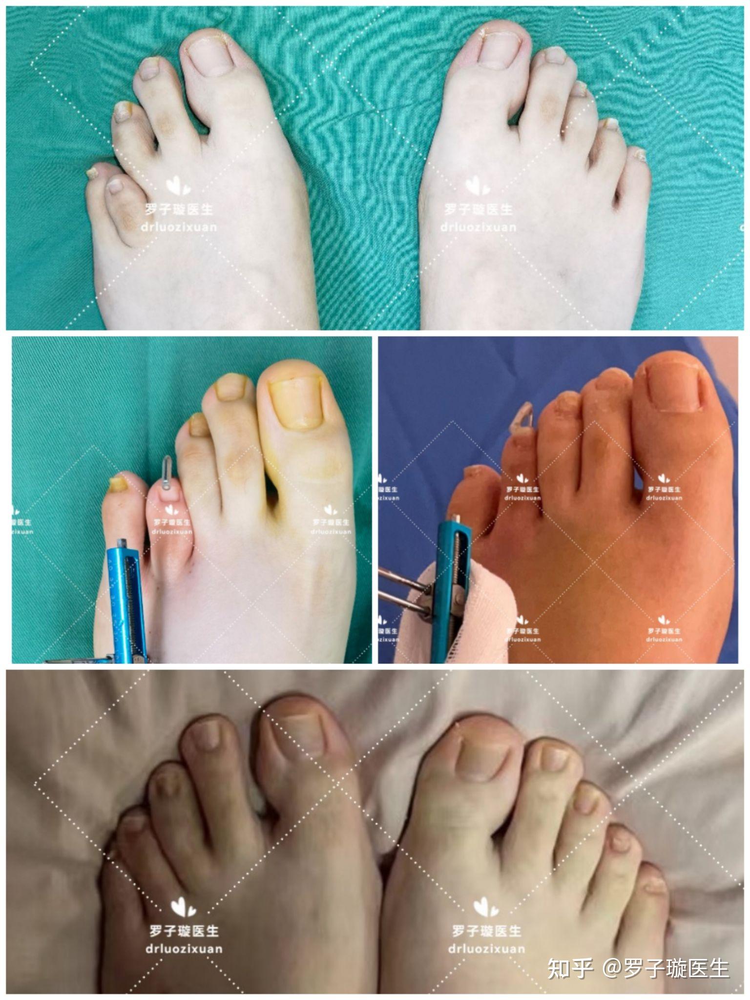 各种类型短趾症（脚趾短小症）术前术后对比。(持续更新中) 20231030 - 知乎