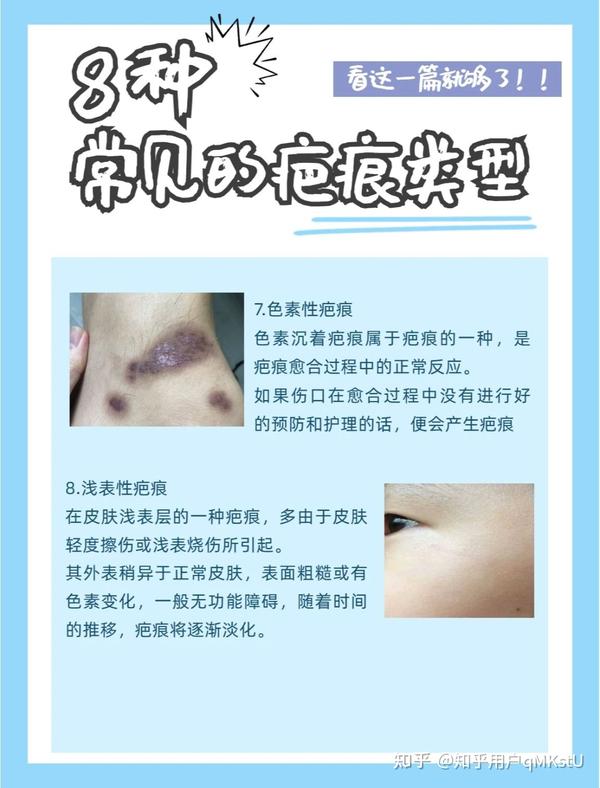 科普疤痕小知识 - 知乎