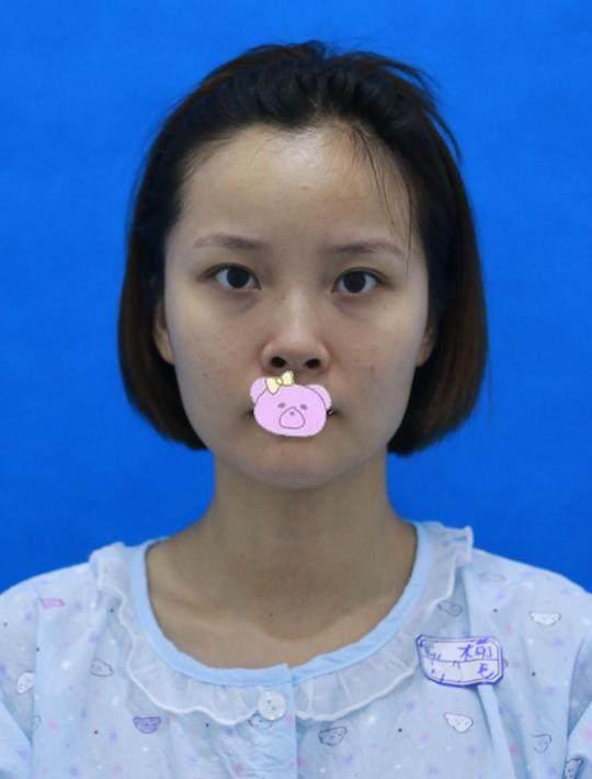 【真人案例】猪鼻子做鼻综合直接变成韩佳人同款小翘鼻