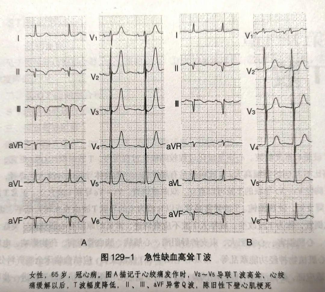 t波v2v3高耸图片