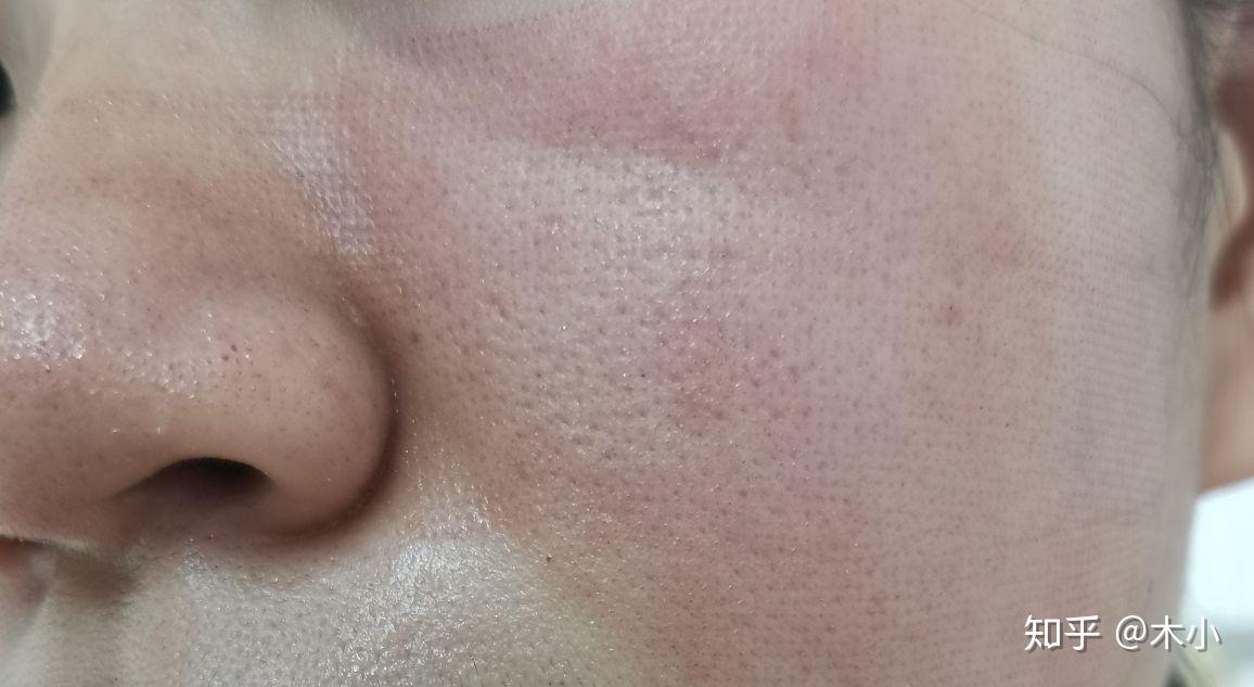 记录一下点阵激光收缩毛孔全过程